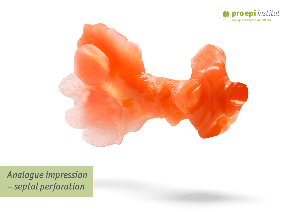 Analogue impression  septal perforation