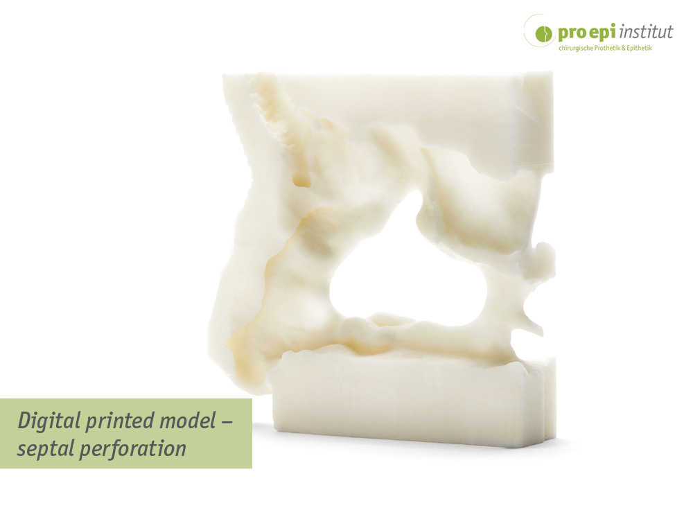 Digital printed model  septal perforation