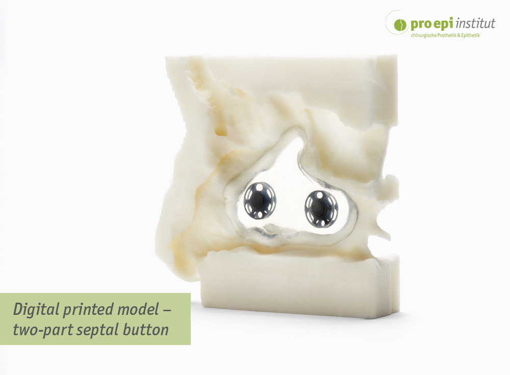 Digital printed model  two-part septal button