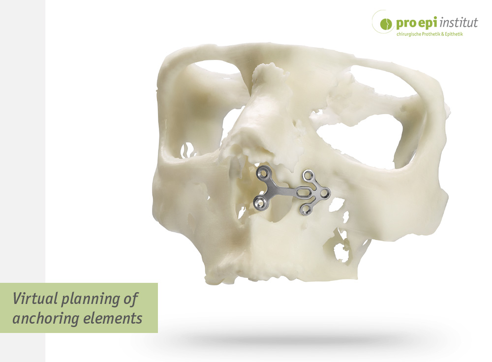 Virtual planning of anchoring elements