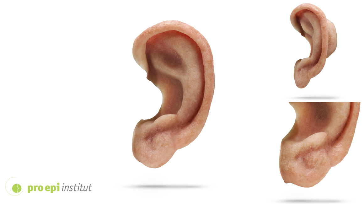 epitheses ear