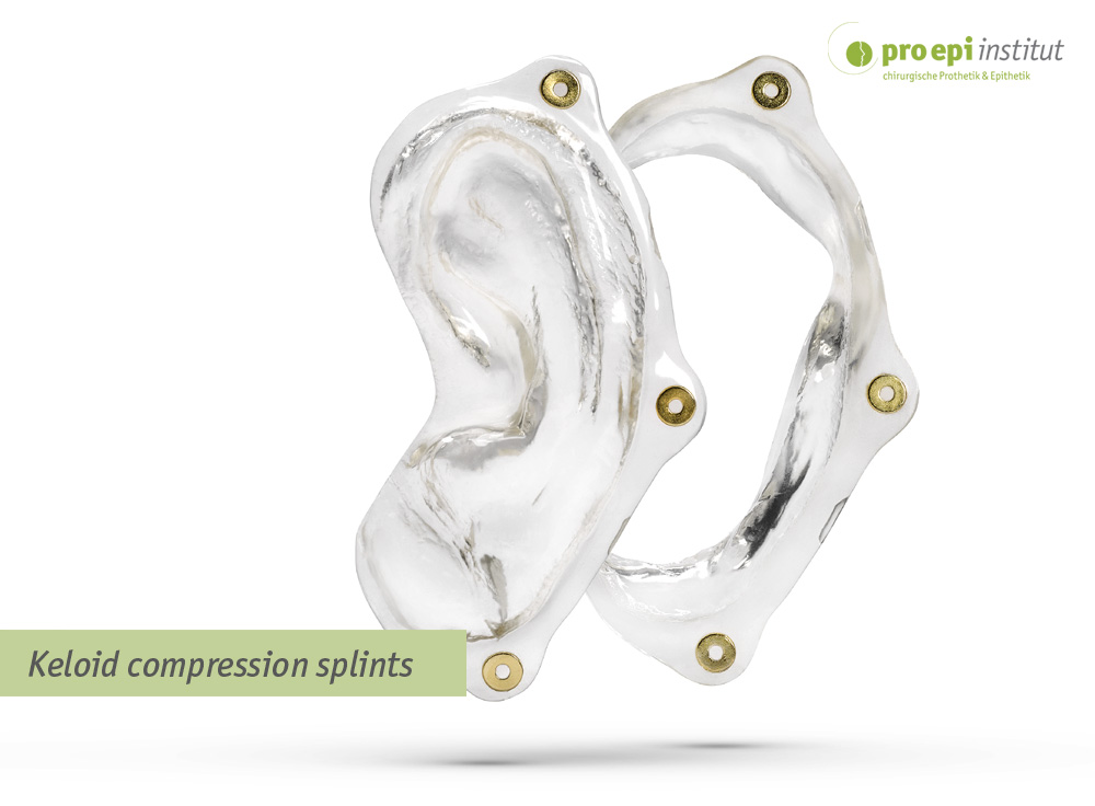 Keloid compression splints