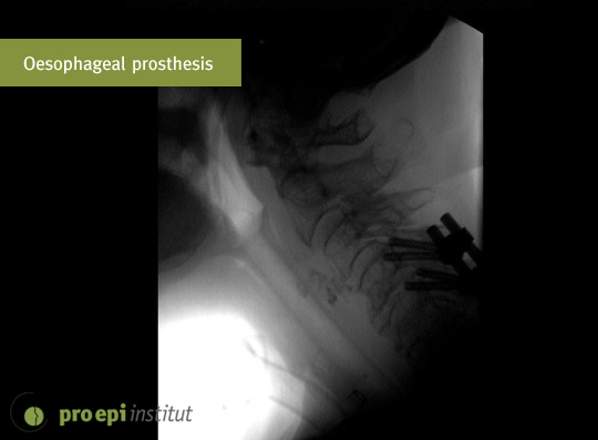 Oesophageal prosthesis with food valve
