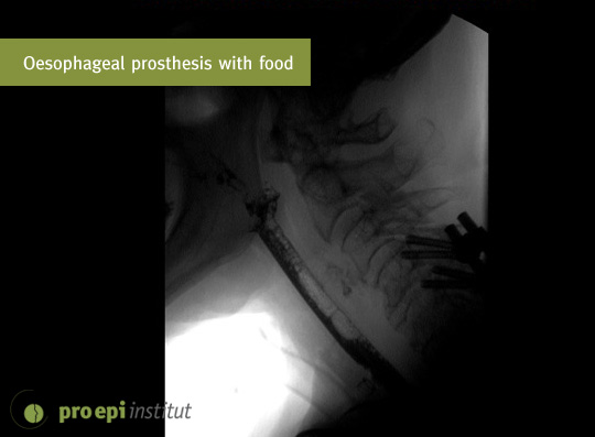 Oesophageal prosthesis with speech