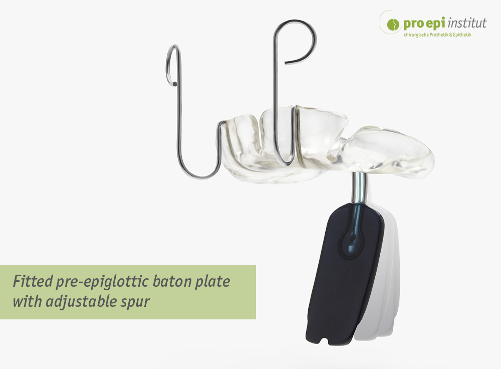 Fitted pre-epiglottic baton plate with adjustable spur
