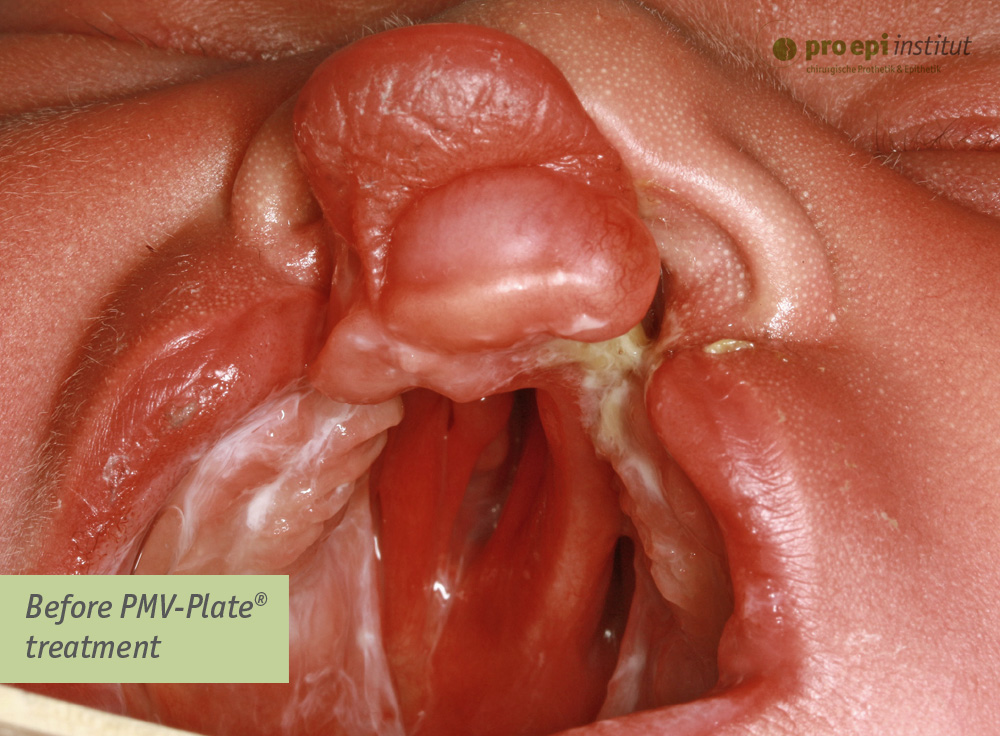 Before PMV Plate® treatment