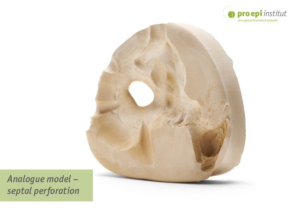 Analogue model � septal perforation