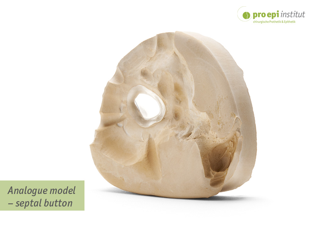 Analogue model  septal button