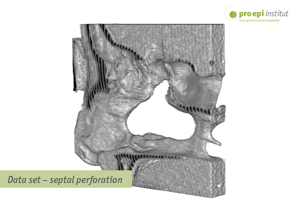 Data set  septal perforation