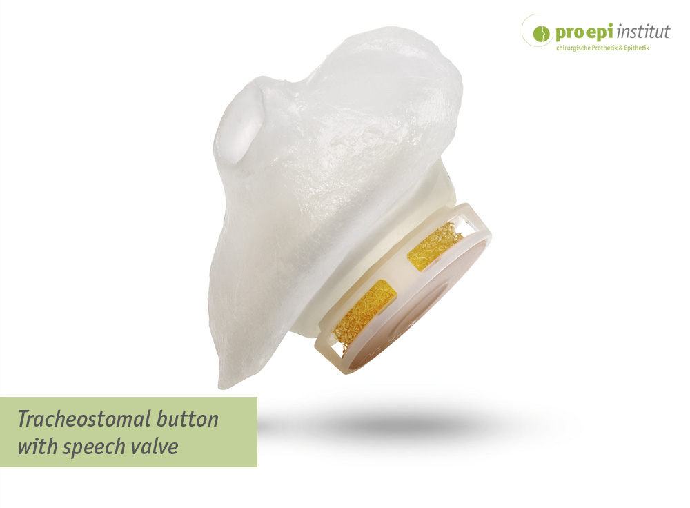 Tracheostomal epithesis with speech valve