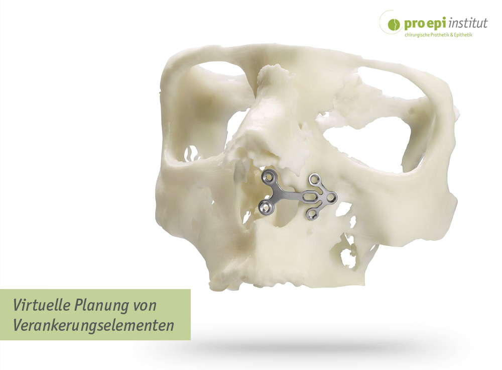 Virtuelle Planung von Verankerungselementen