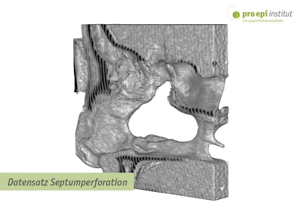 Datensatz Septumperforation