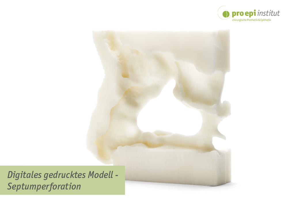 Digitales gedrucktes Modell - Septumperforation