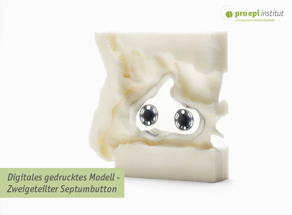 Digitales gedrucktes Modell - Zweigeteilter Septumbutton